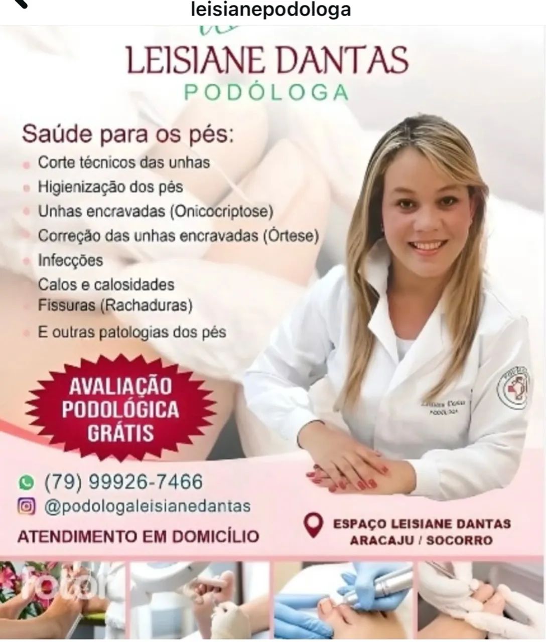 Tratamento de calosidade com Leisiane Dantas Podóloga - Foto 2