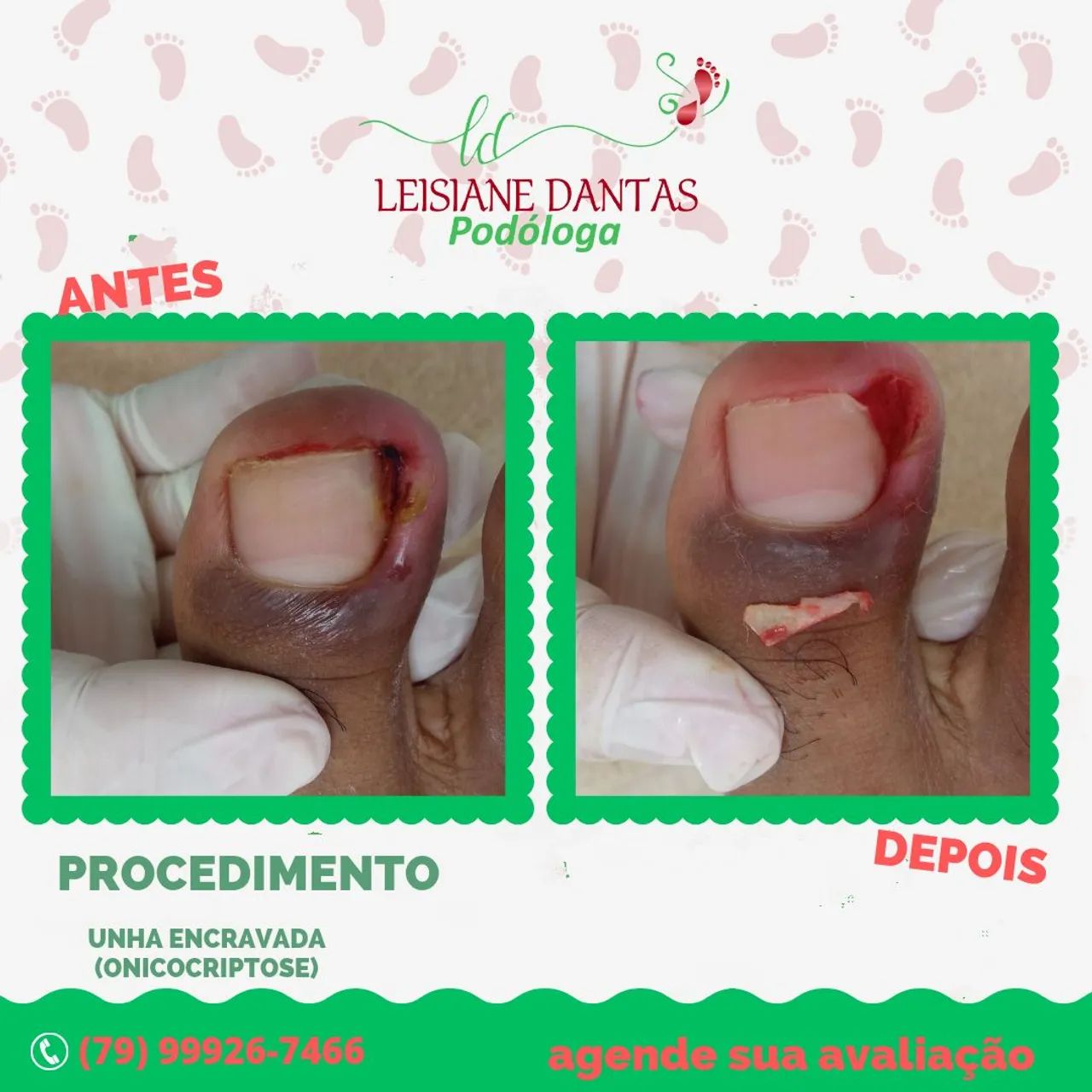 Unha Encravada? Livre-se do problema com Podóloga! - Foto 2