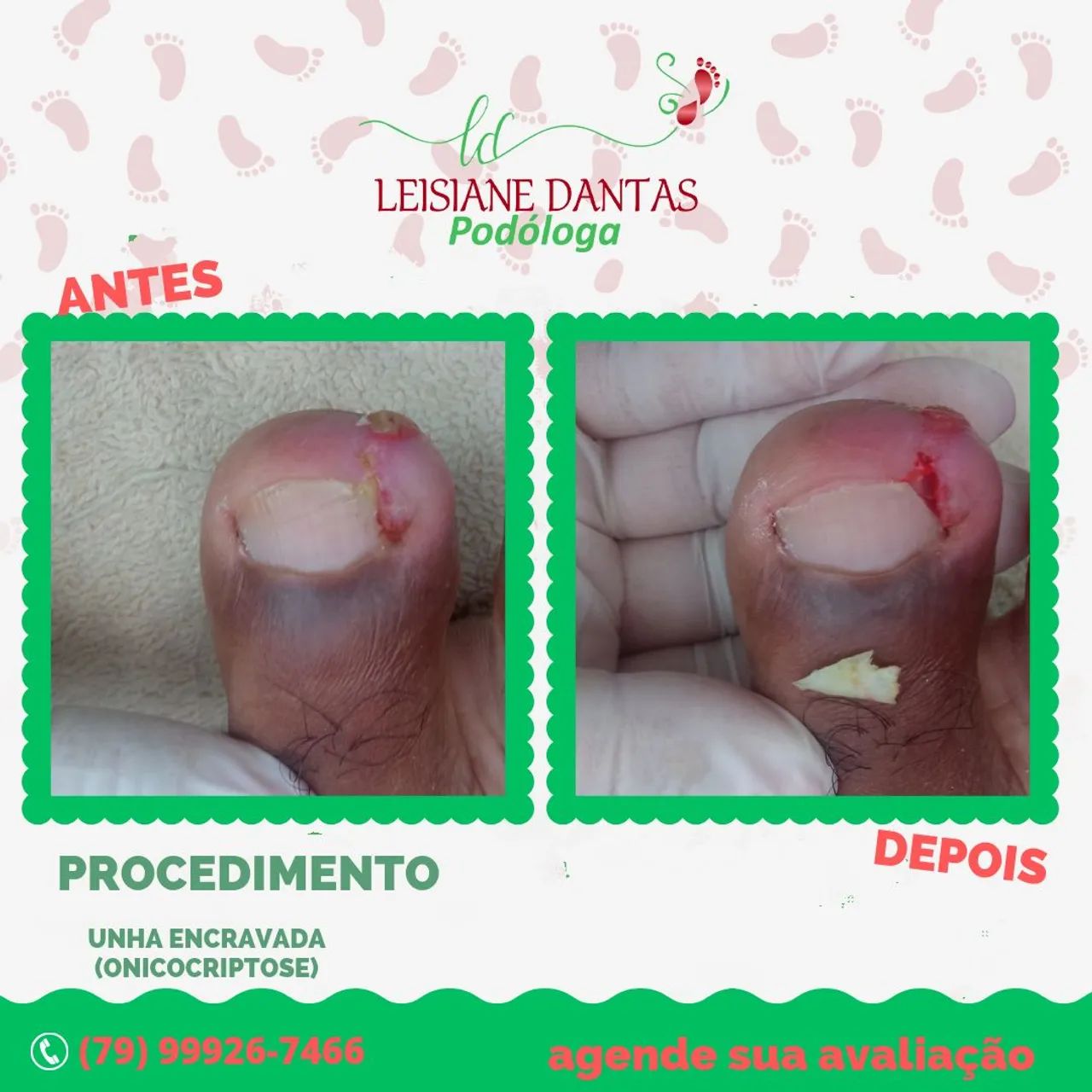 Unha Encravada? Livre-se do problema com Podóloga! - Foto 3