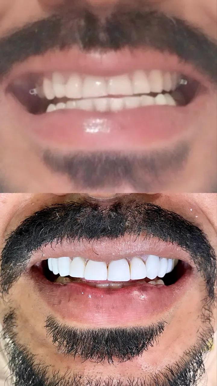 Facetas em resina  - Foto 4