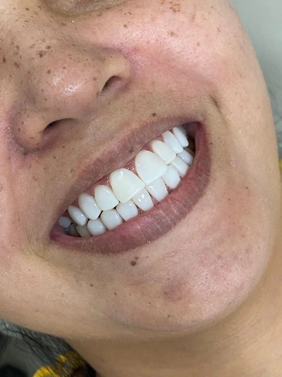 FACETAS DE RESINA 