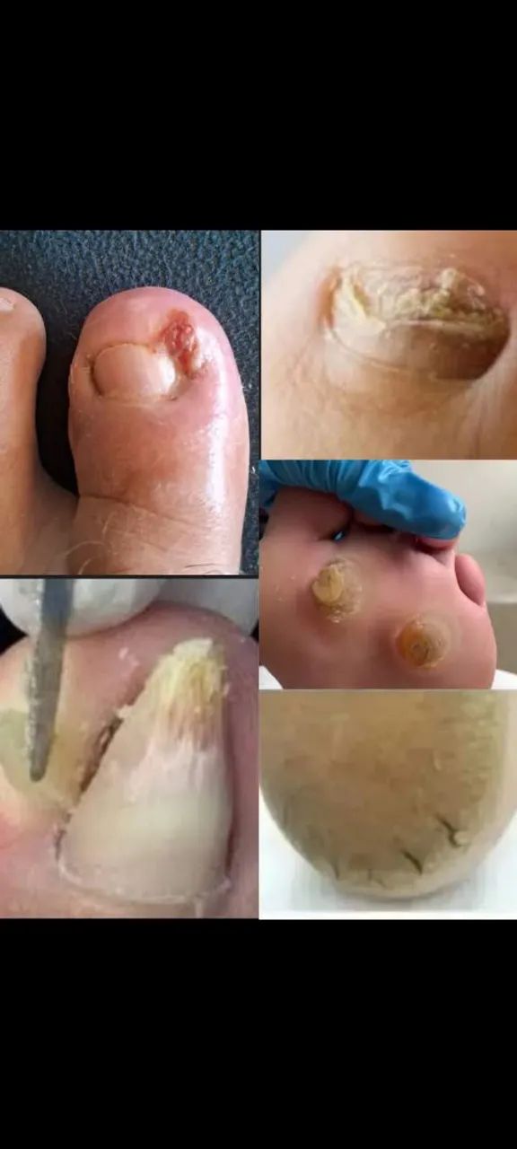 Paula Sanches Podóloga cuidando da saúde dos seus pés ? - Foto 5
