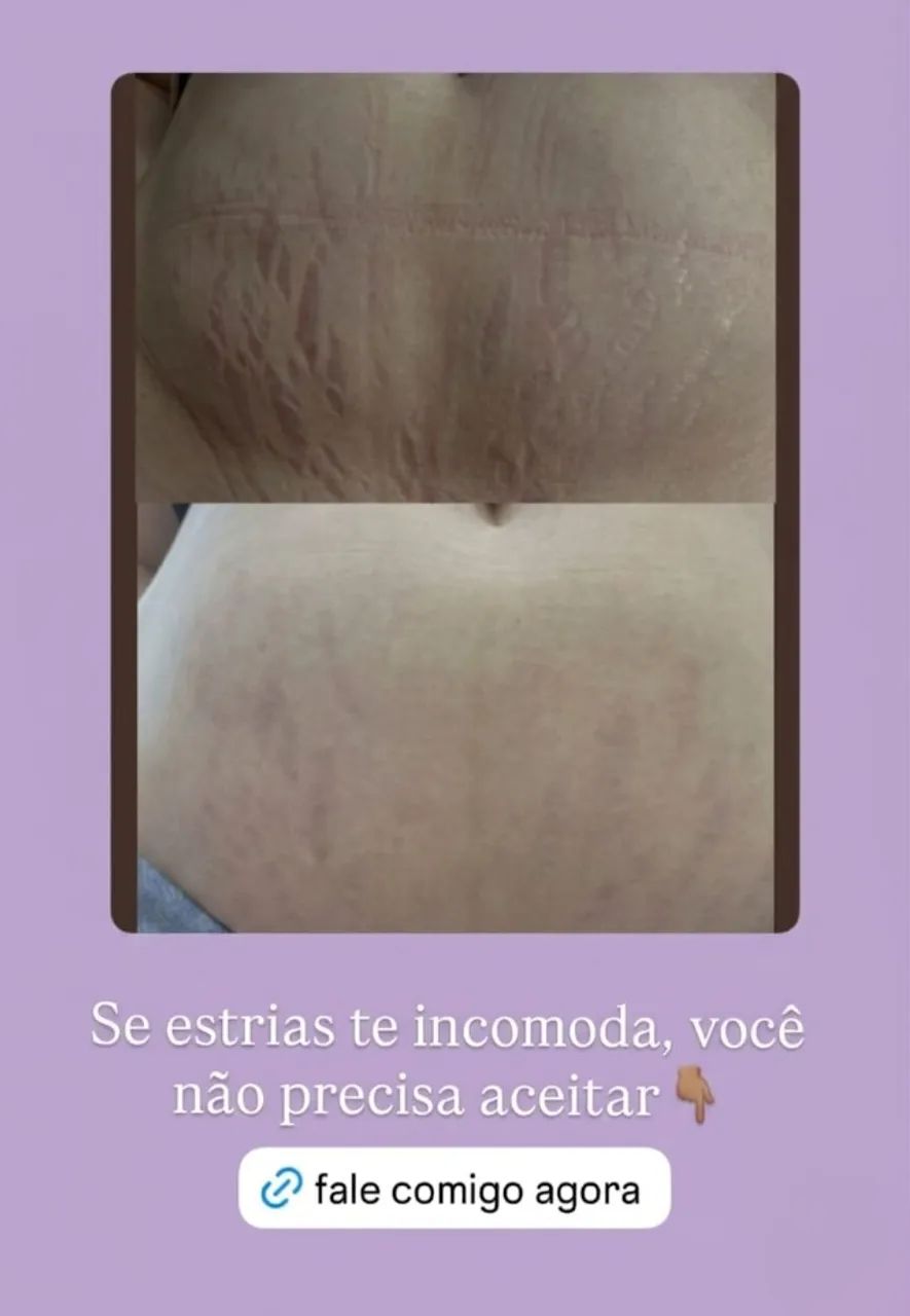 Tratamento de Estrias e flacidez