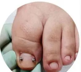 Aparelho Ortodôntico para Unhas - Novo - Foto 2