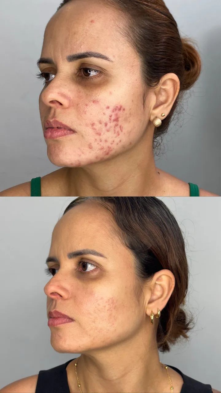 Tratamento de acne 