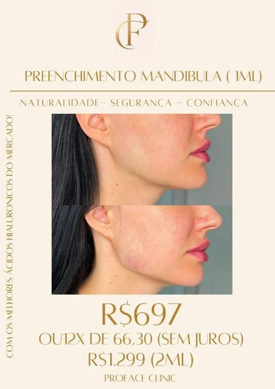 PREENCHIMENTO DE MANDÍBULA