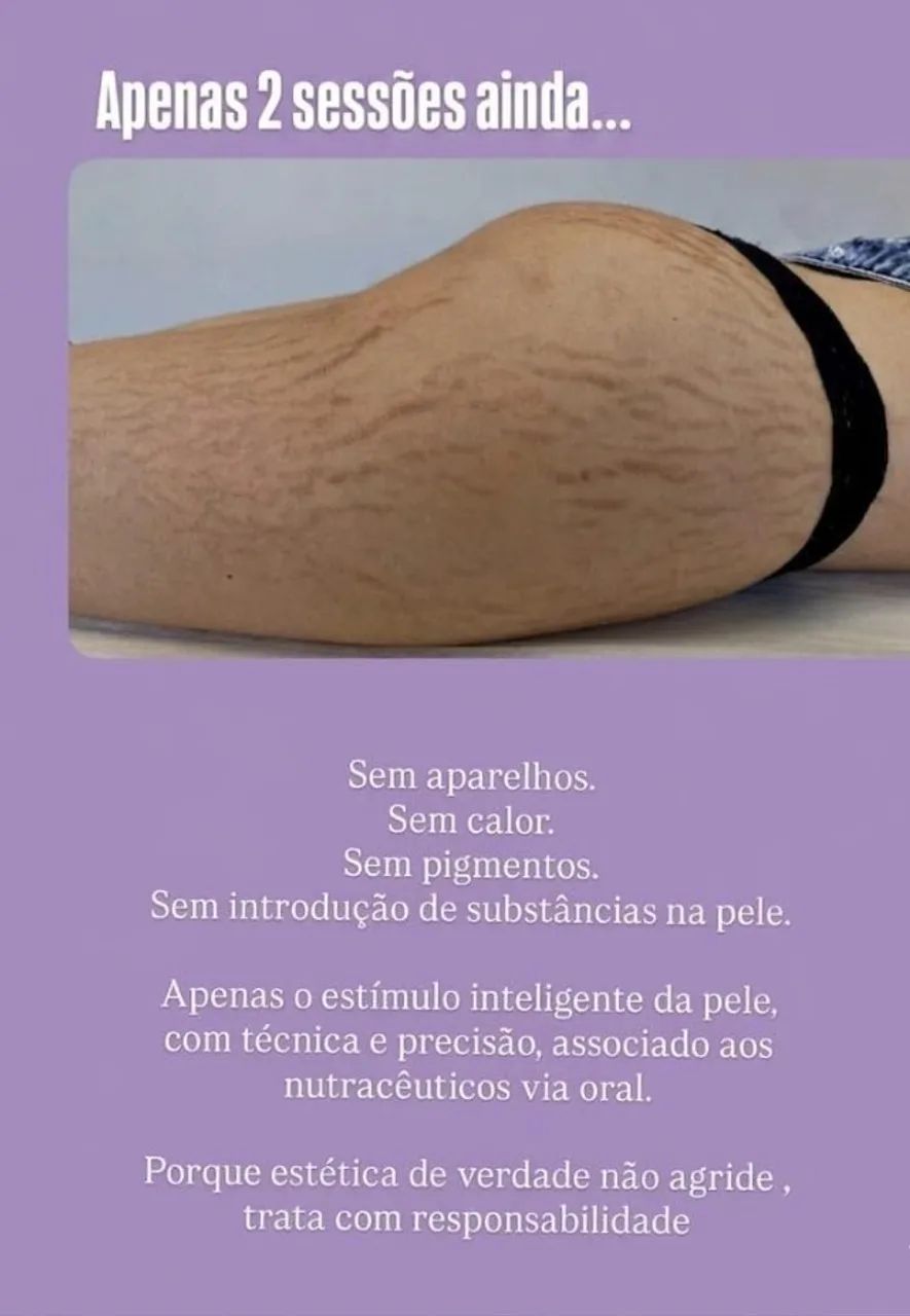 Tratamento de Estrias e flacidez - Foto 3