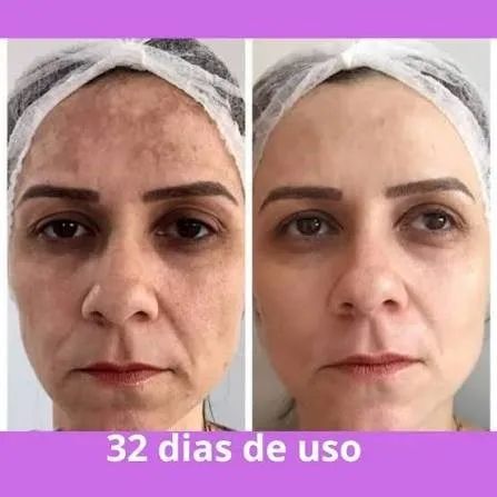 Clareador de Manchas de pele Amazon Kaps - PAGUE SÓ NA ENTREGA!!! - Foto 3