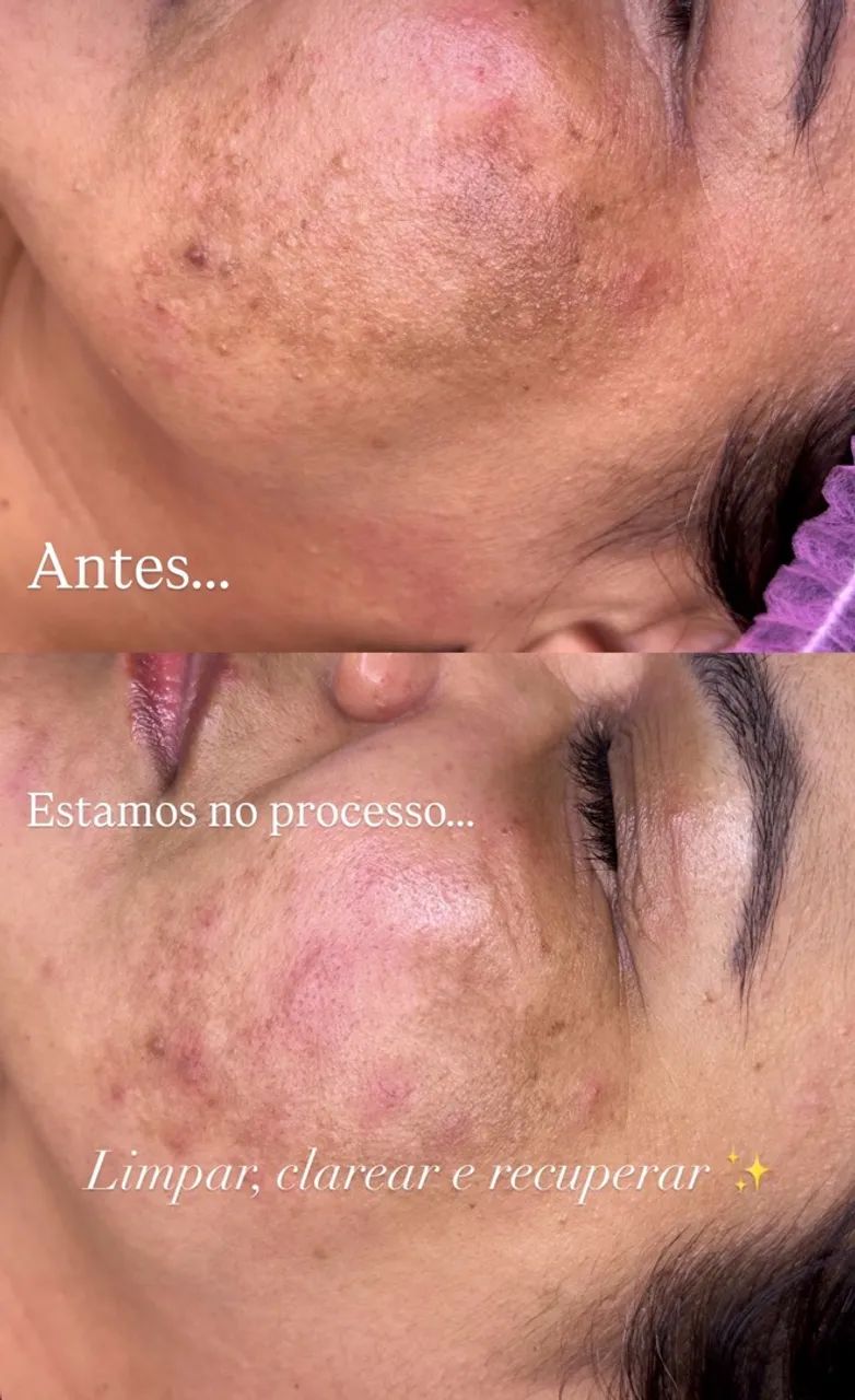 Curso limpeza de pele  - Foto 4