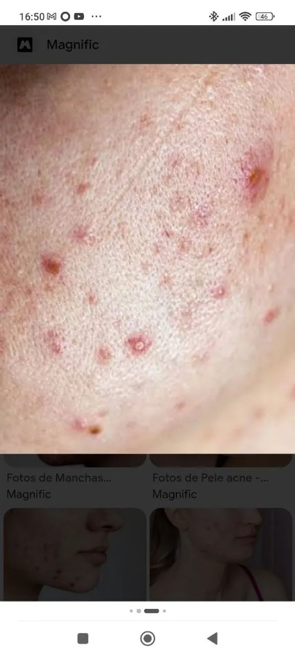 Acne (espinhas).