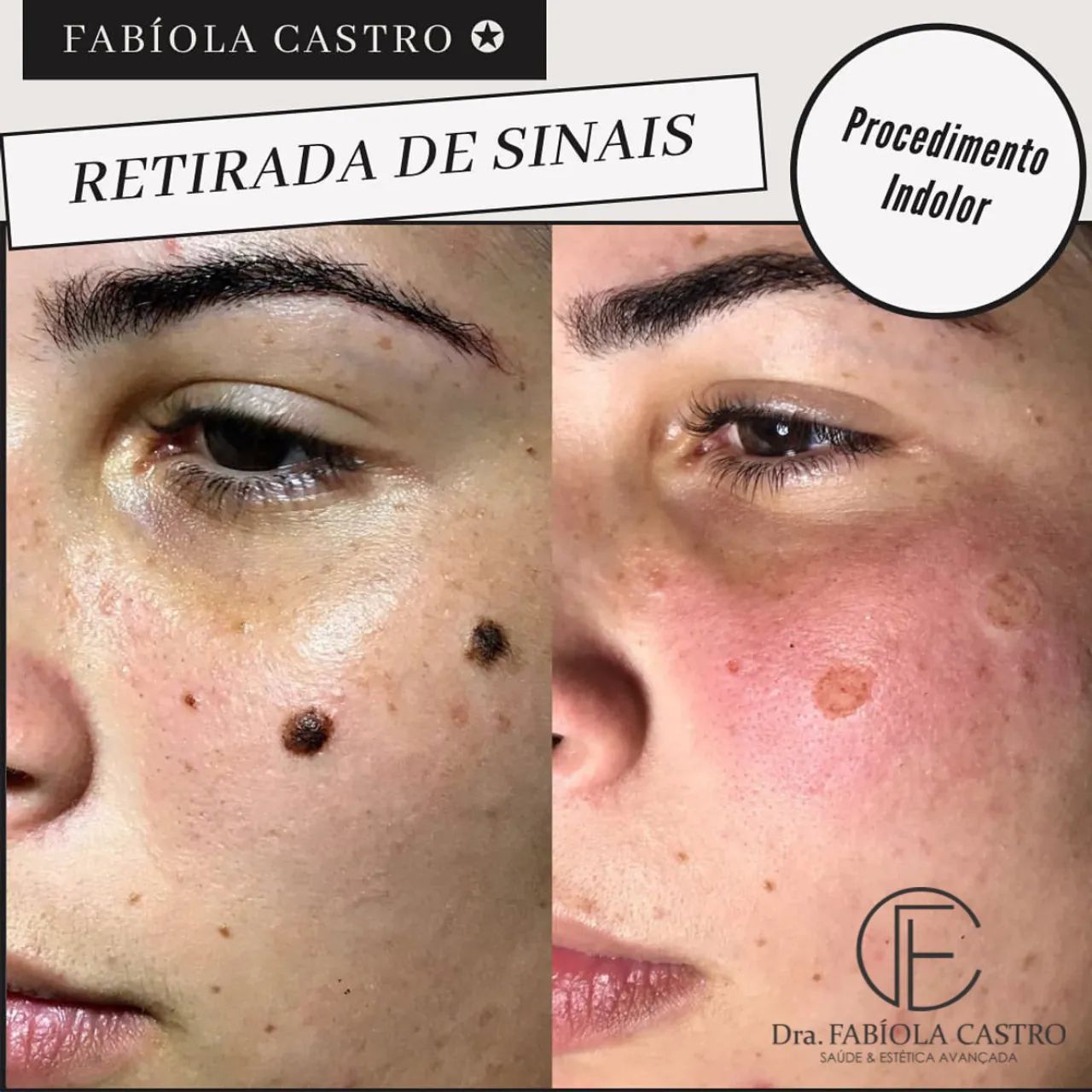 Remoção de sinais | São Luís 