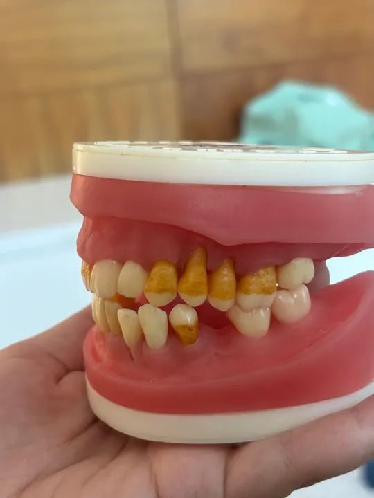 Refil de periodontia