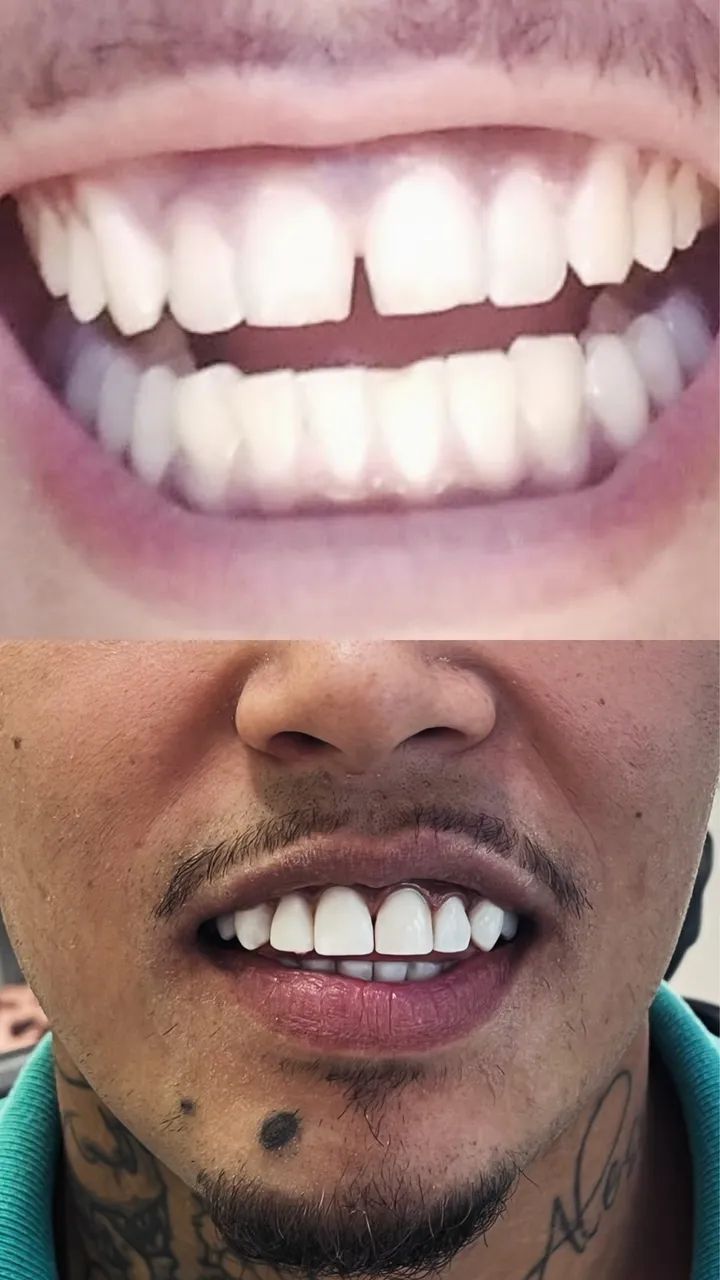 Facetas em resina  - Foto 5