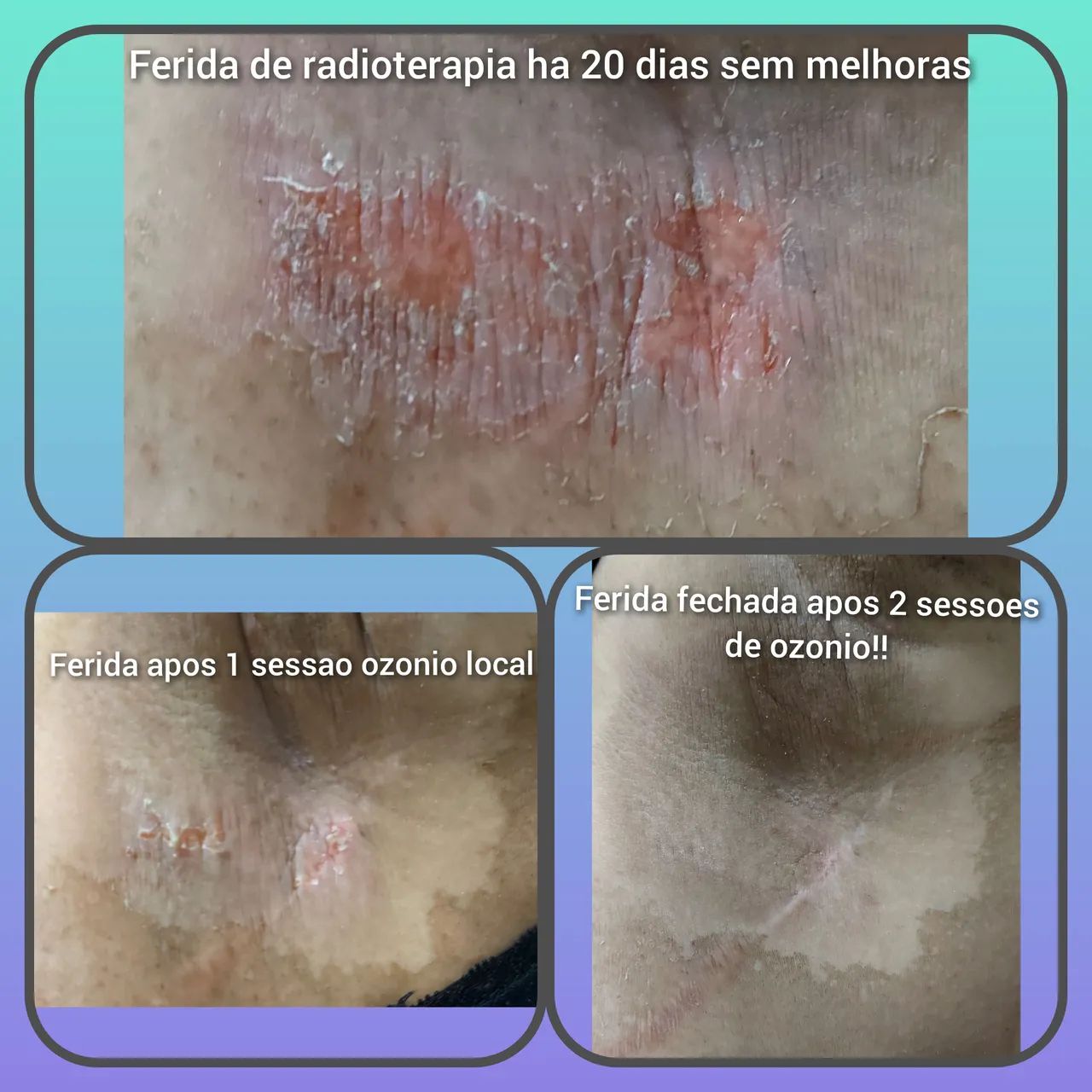 Ozônioterapia e auto hemoterapia  - Foto 2