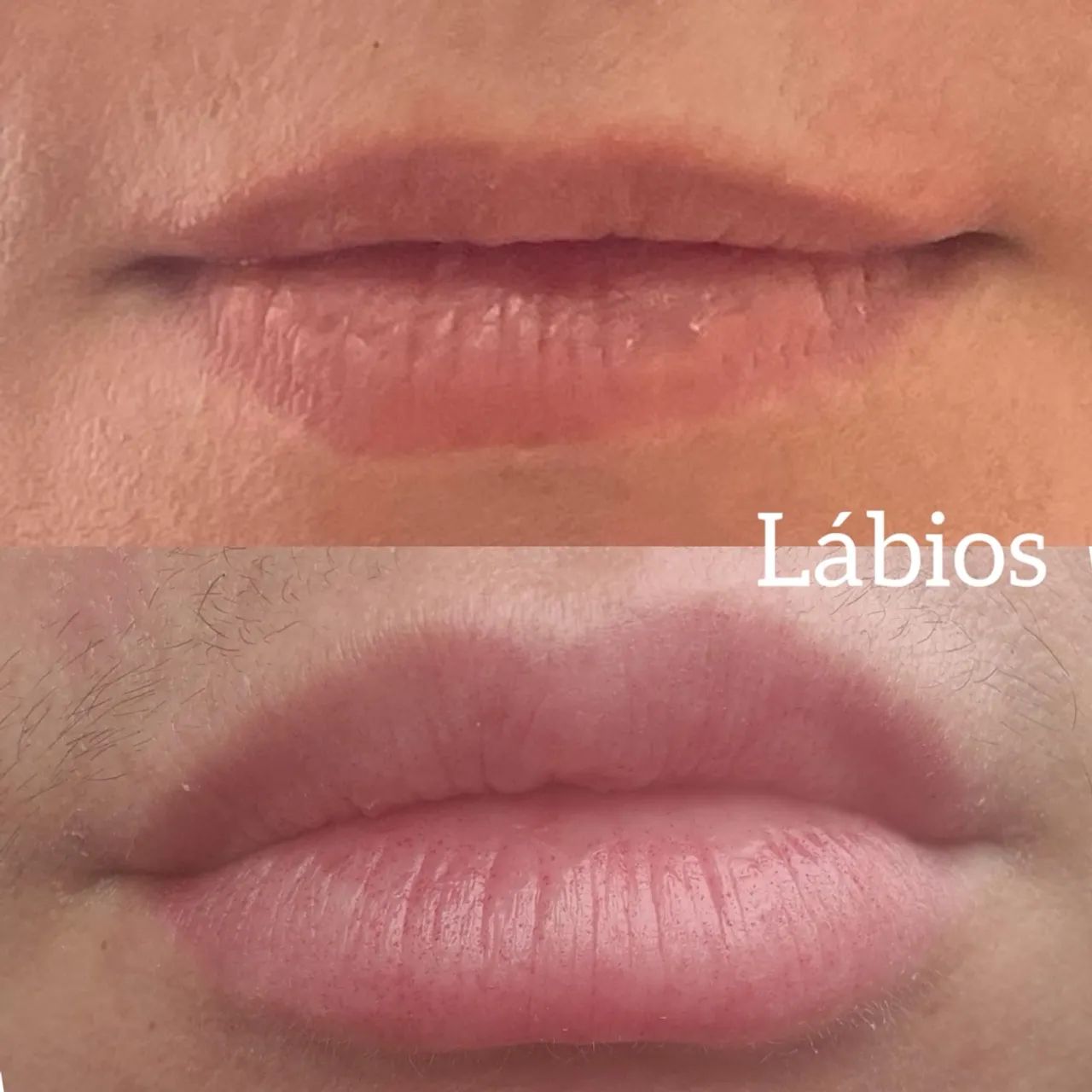 Lábios preenchidos 