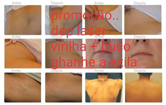 Depilação a Laser ( a domicílio )