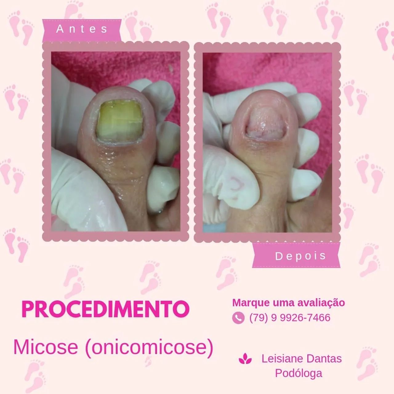 Aparelho Ortodôntico para Unhas - Novo - Foto 5
