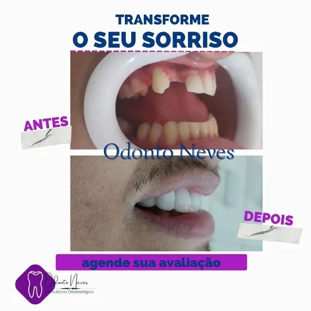 FACETAS DE RESINA - Foto 4