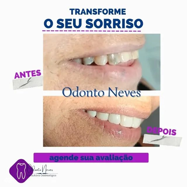 FACETAS DE RESINA - Foto 3
