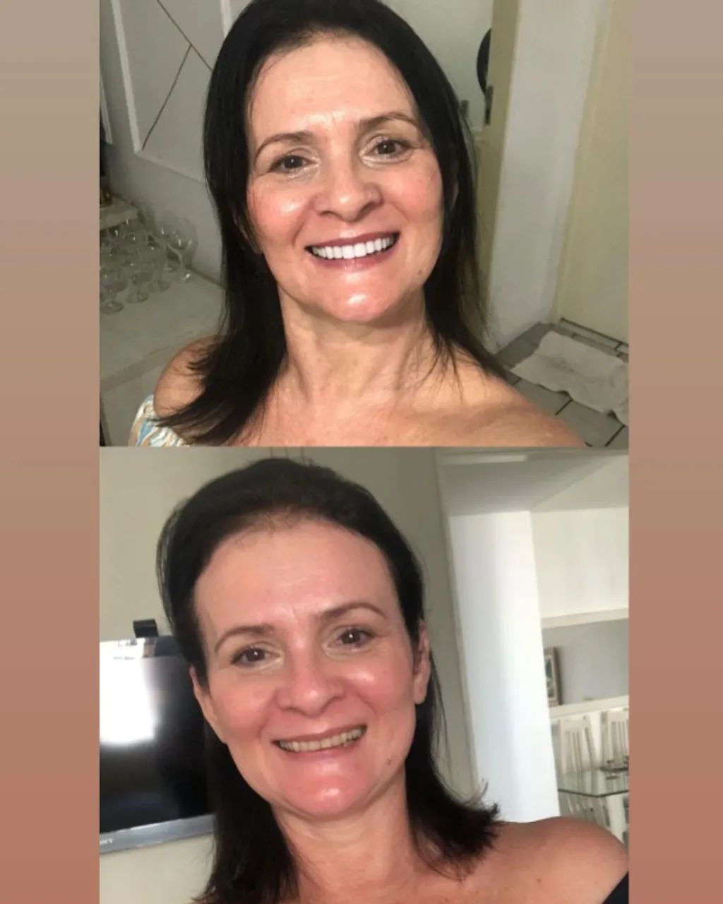 FACETAS DE RESINA - Foto 2