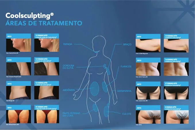 Equipamento Médico CoolSculpting - Foto 4