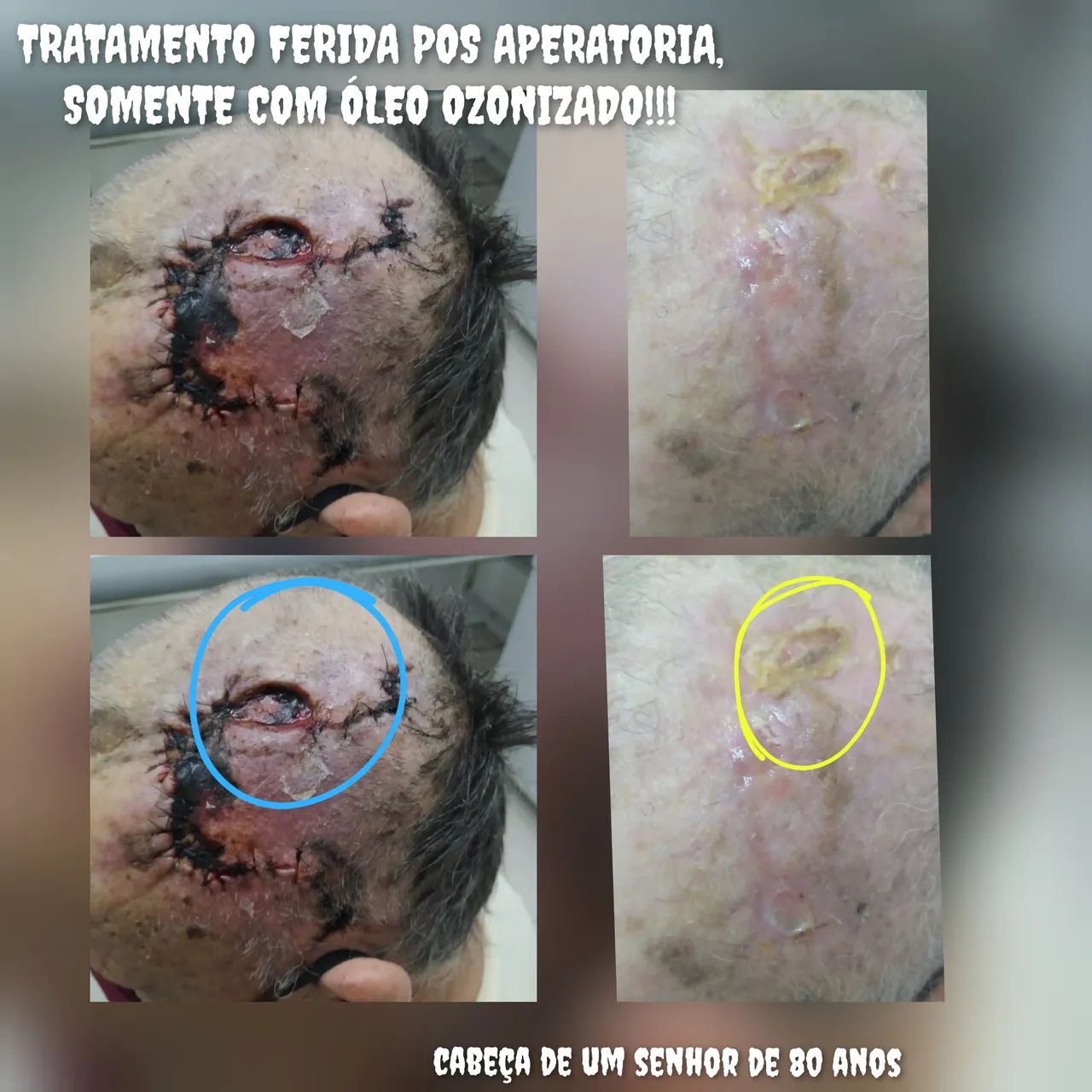 Ozônioterapia e auto hemoterapia  - Foto 3