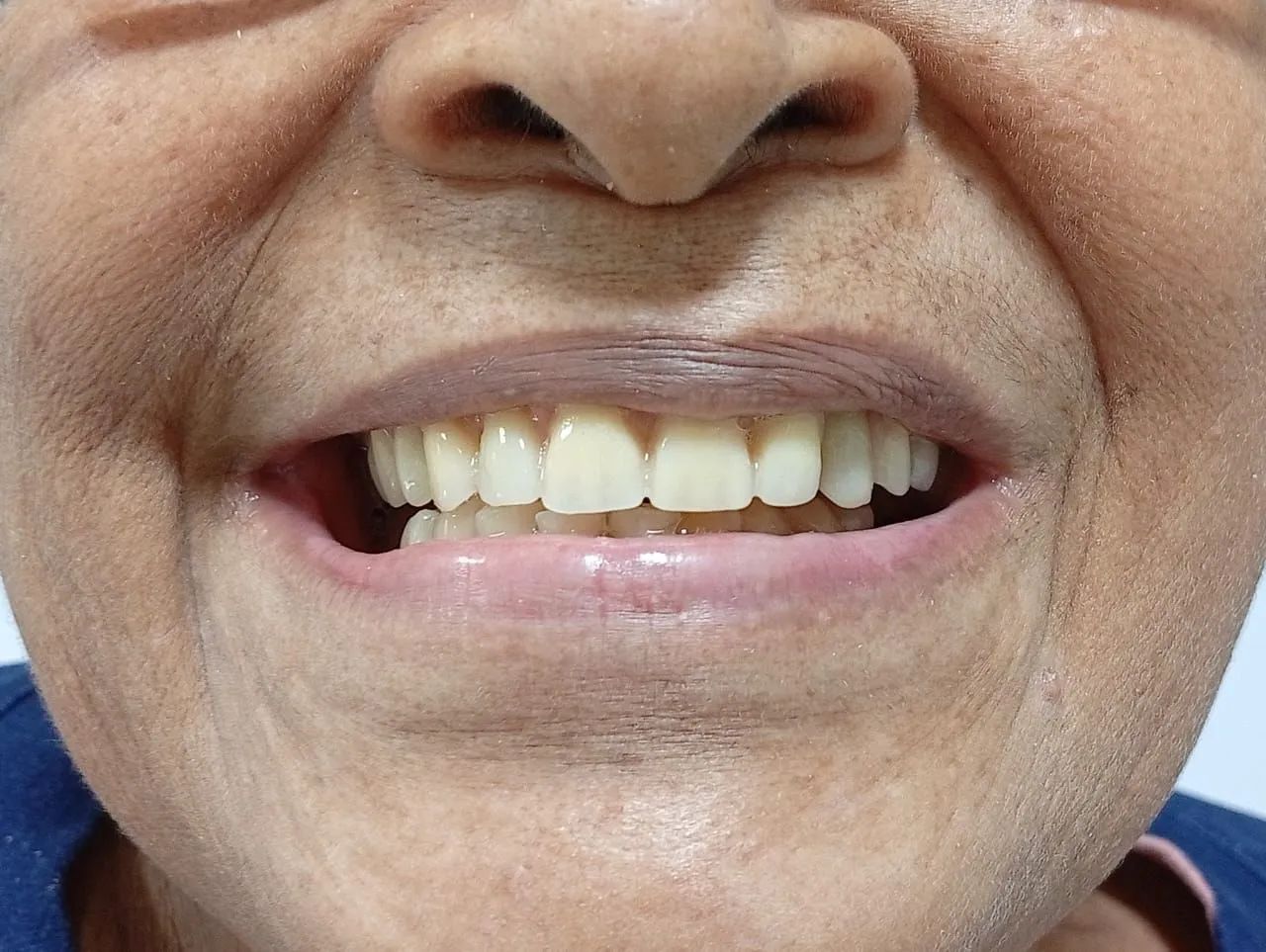Dentadura