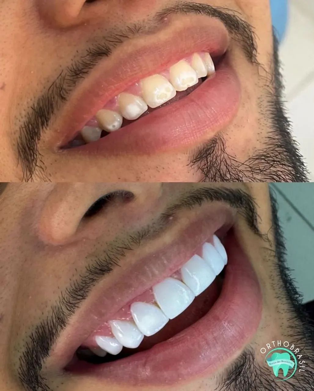 Facetas em resina  - Foto 2