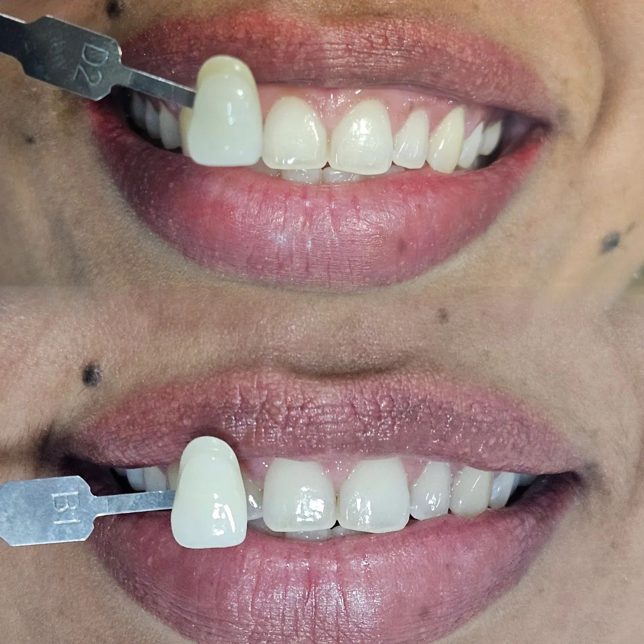 Clareamento Dental