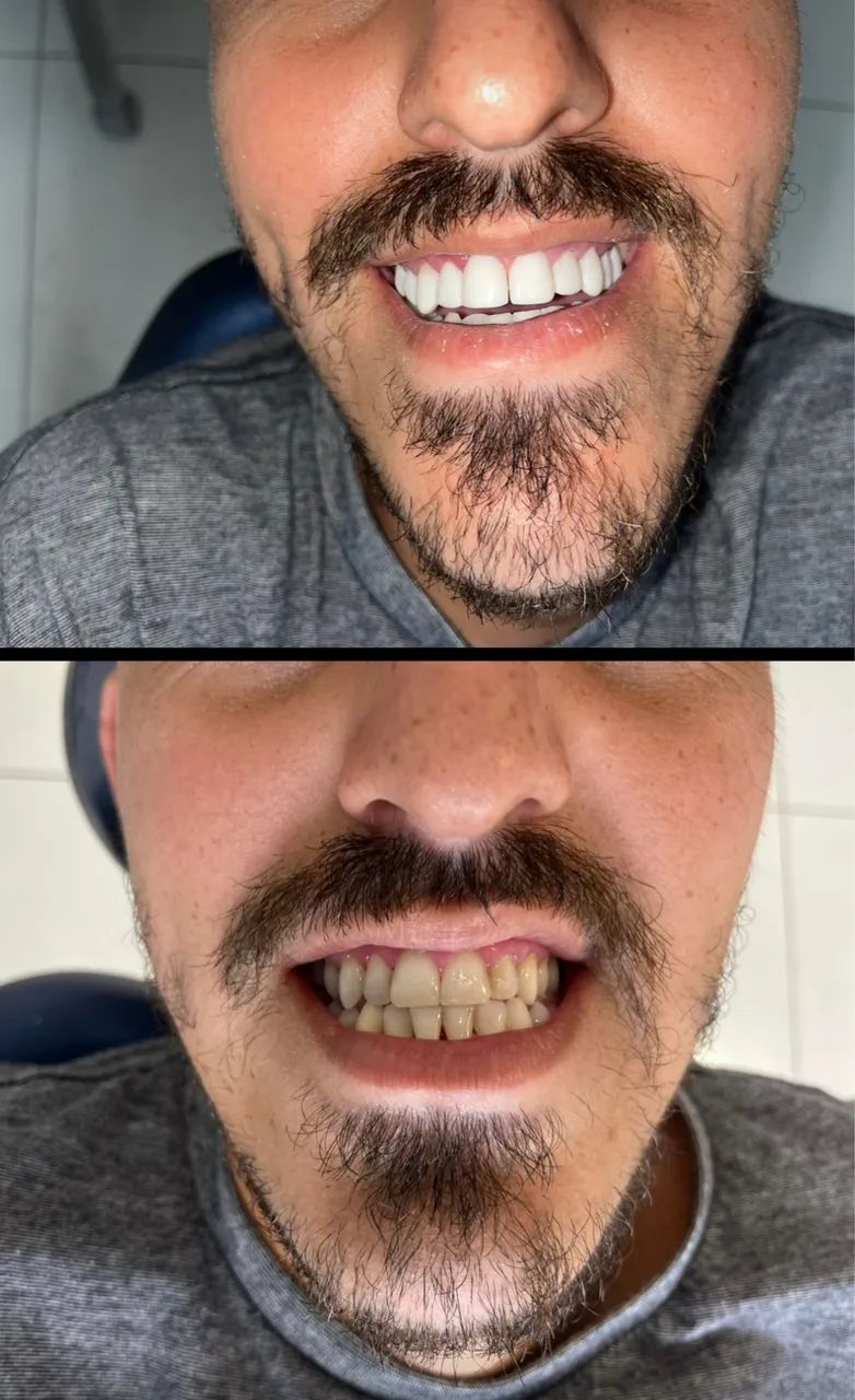 Facetas em RESINA (PROMOÇÃO R$1.999) - Foto 2