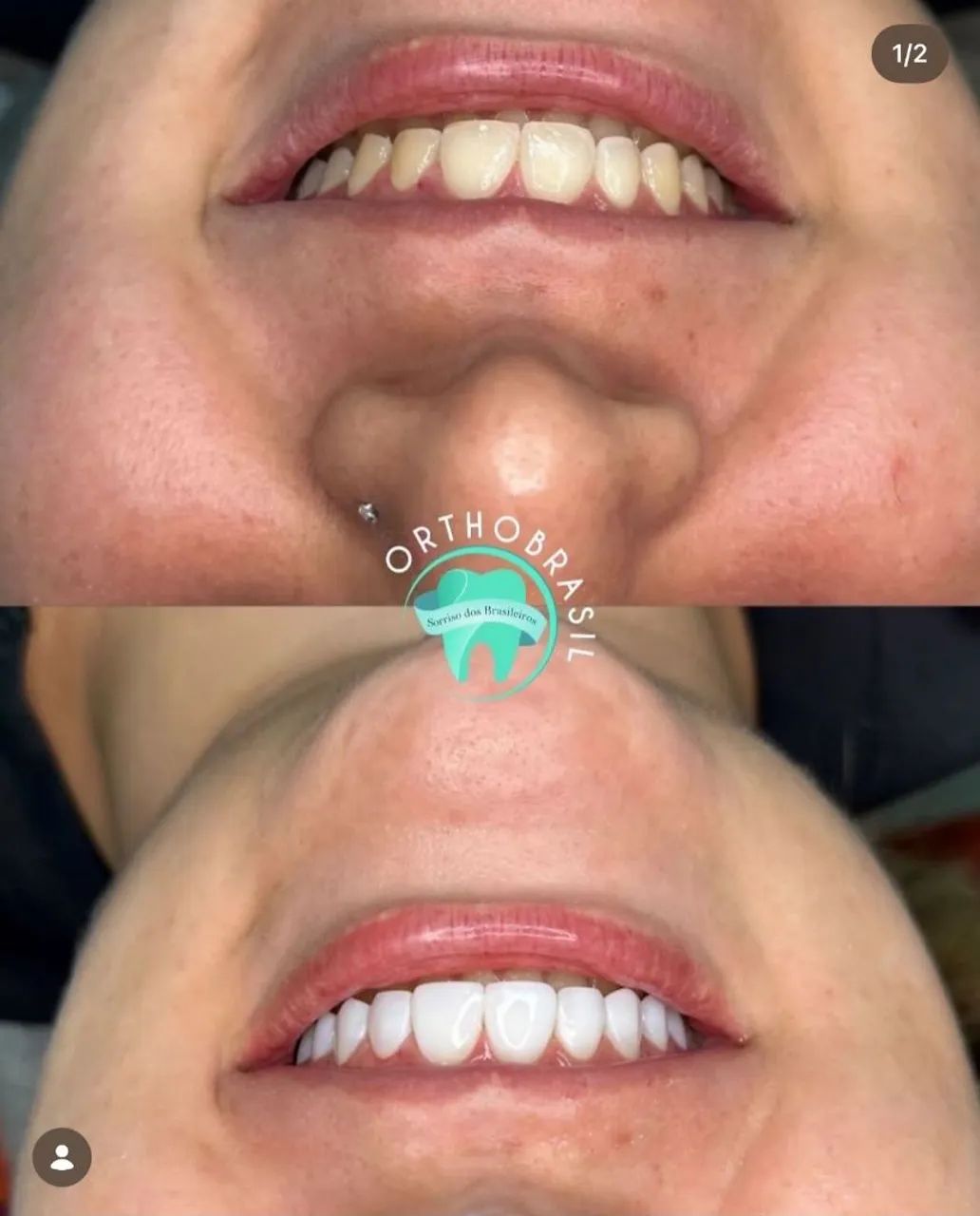 Facetas em resina  - Foto 3