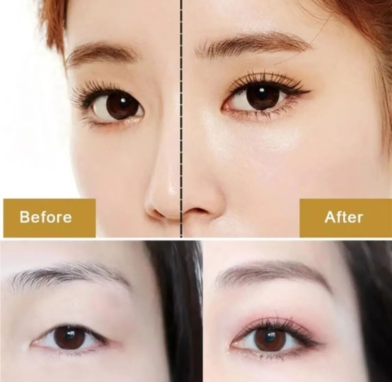 Cola pra Redução de Pálpebras 