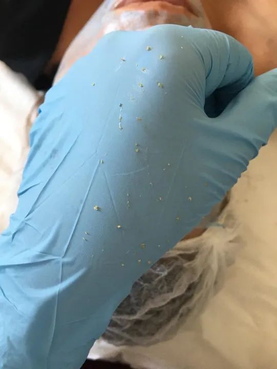 Limpeza de pele Enzimática - Foto 4