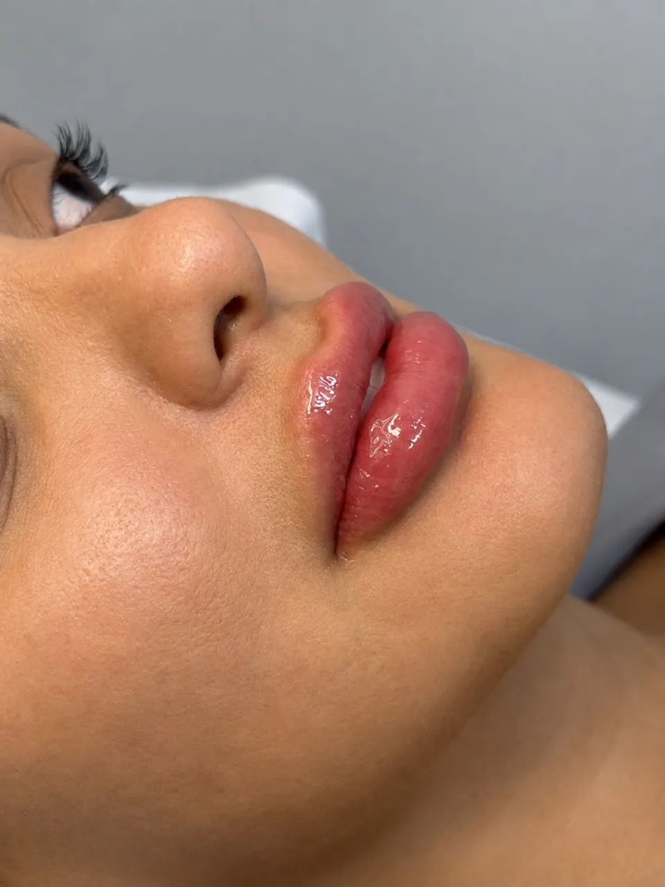 Preenchimento labial / paciente modelo 