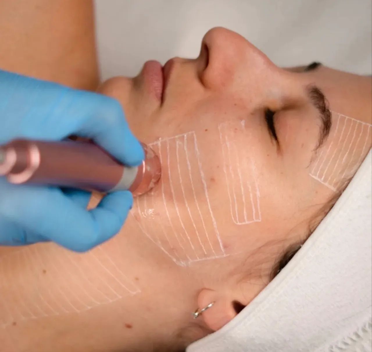 Ultrasson Microfocado Visage - Foto 3