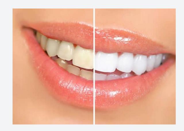 Clareamento dos Dentes ( atendimento a domicilio)