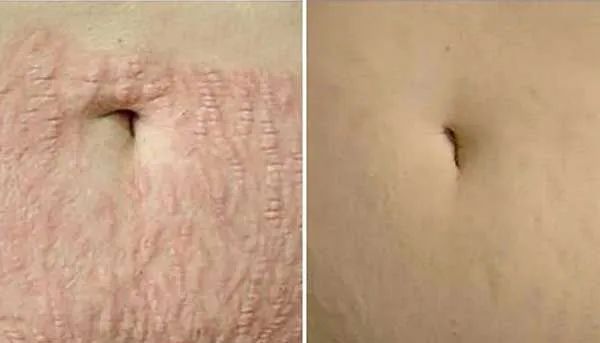  Jato de plasma  - Foto 3