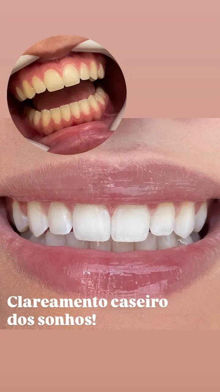 Protese dental (próteses, bride, dentaduras, pererecas, chapas, provisórios, implantes et - Foto 3