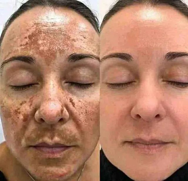 Clareador de Machas Ácido Glicólico - Foto 3