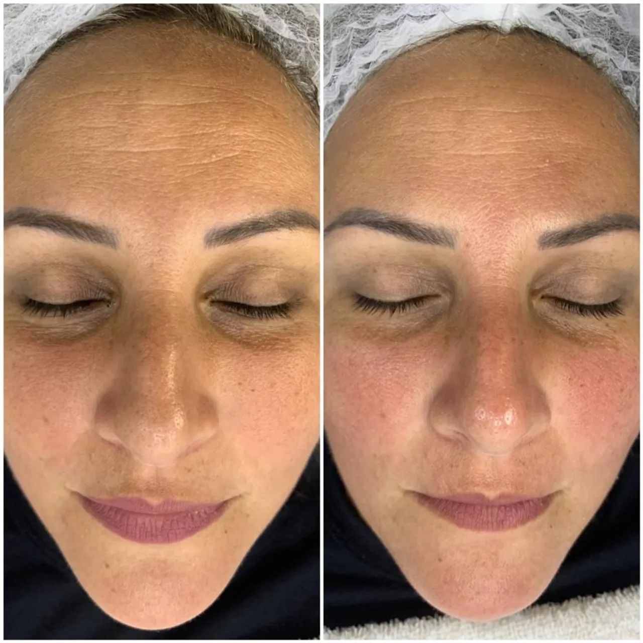 Tratamento facial para rejuvenescimento