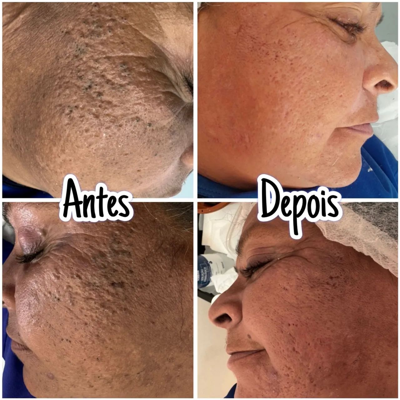 Limpeza de pele promocional