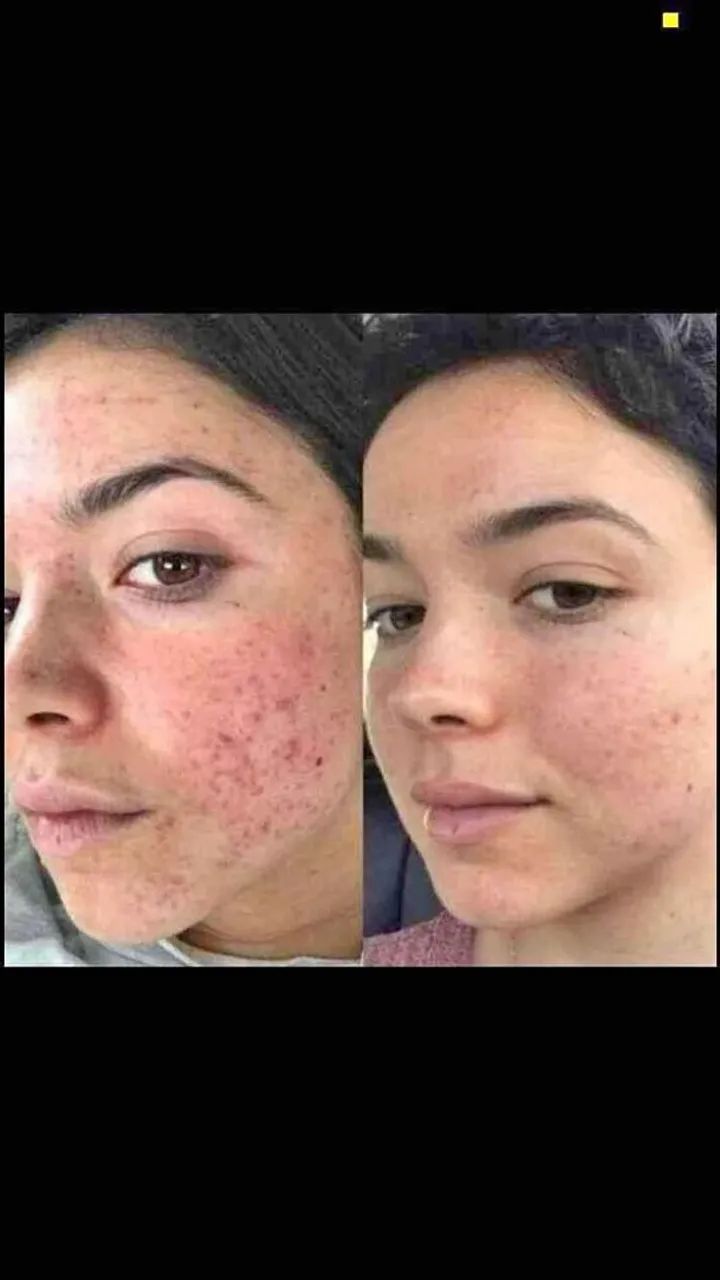 Clareador de Machas Ácido Glicólico - Foto 4