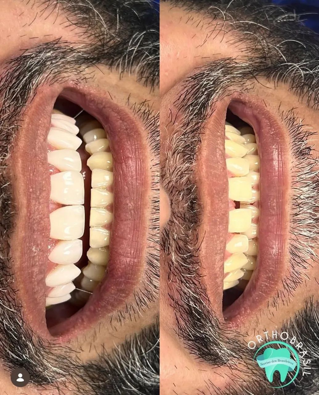 Facetas em resina  - Foto 4
