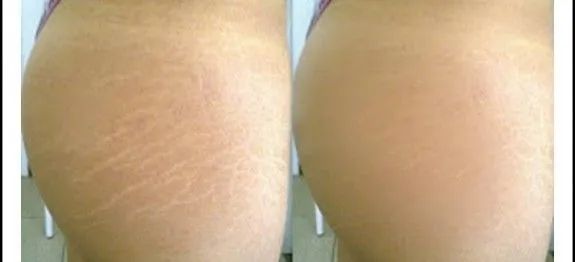  Jato de plasma  - Foto 4