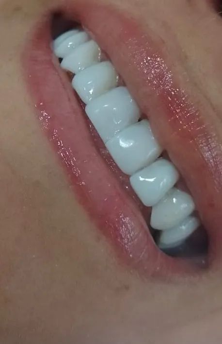 Facetas em resina 