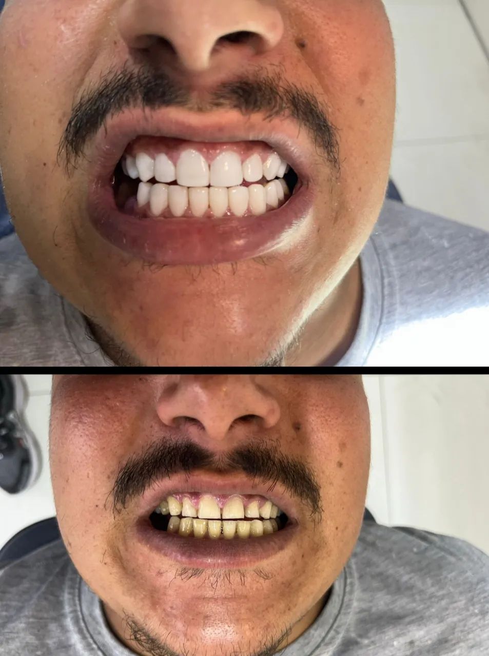 Facetas em RESINA (PROMOÇÃO R$1.999) - Foto 4