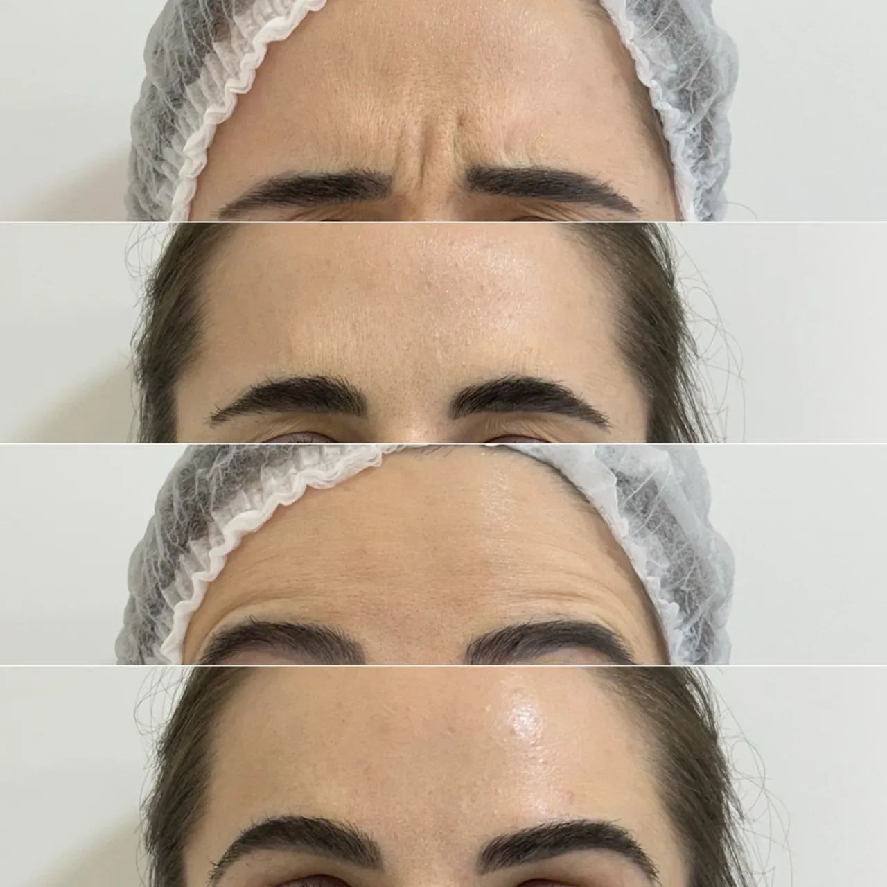 Botox para testa - Resultados incríveis! R$800,00