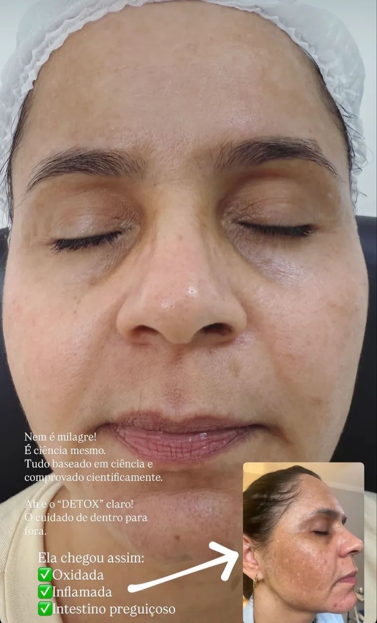 Tratamento para melasma completo e personalizado  - Foto 4