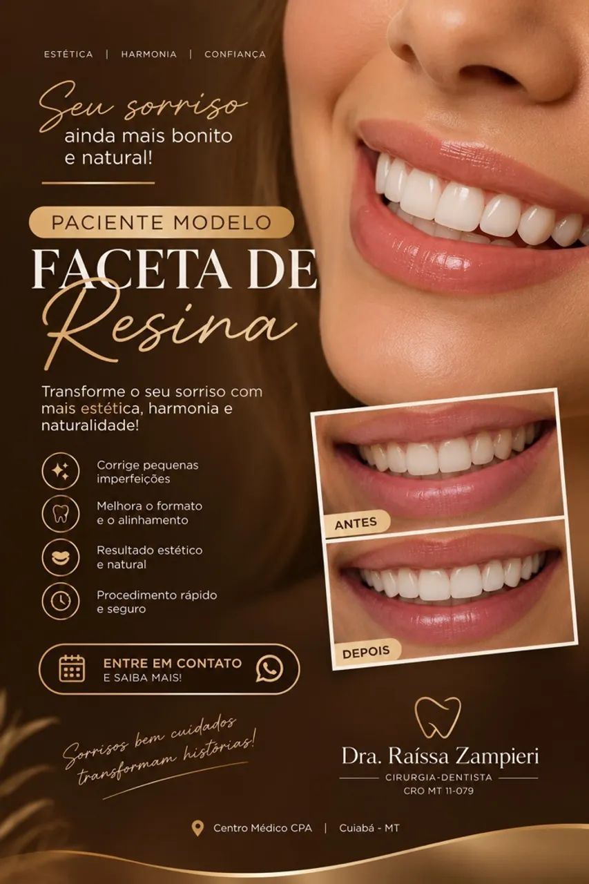 Facetas de resina 