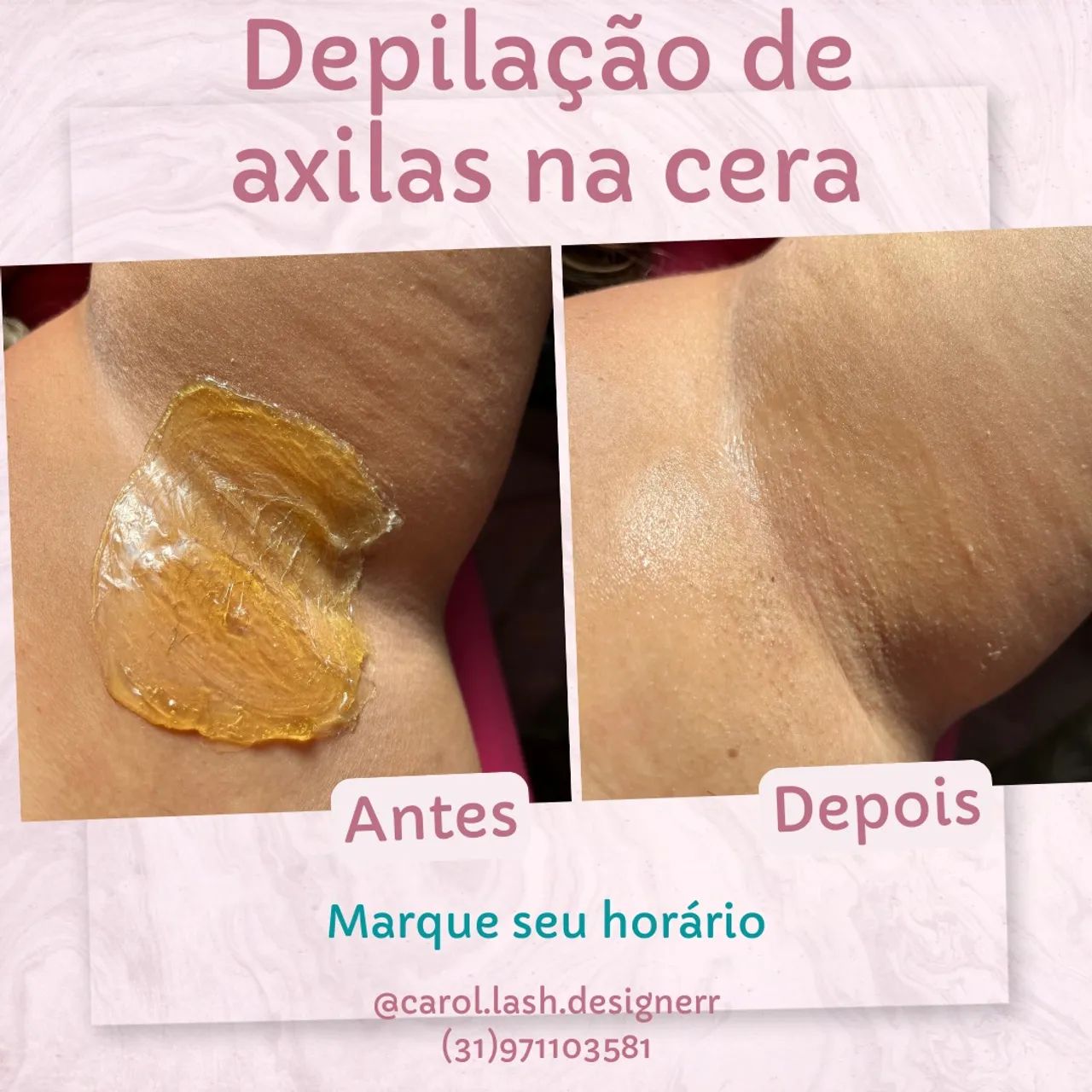 Depilação na cera . Trabalho com depilação feminina 